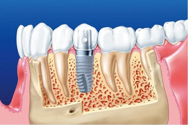 Lịch sử ra đời và phát triển của những chiếc răng giả - Ảnh 2.