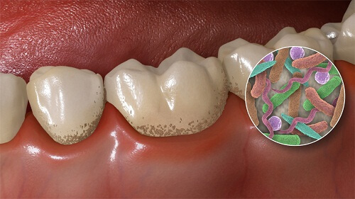 Nếu lạm dụng 5 loại thực phẩm này, răng của bạn có thể bị hỏng lúc nào mà không biết - Ảnh 2.