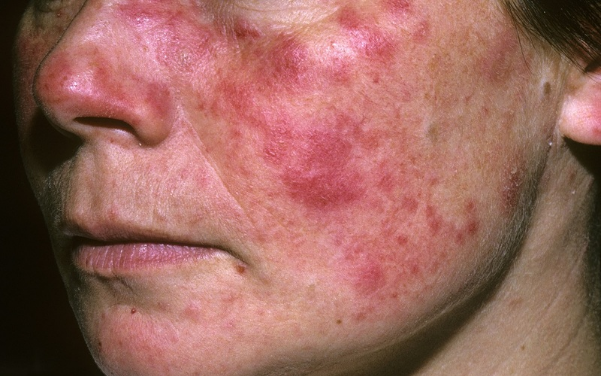 Lupus ban đỏ ảnh hưởng đến tuổi thọ như thế nào?