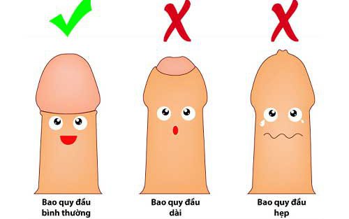 Khi nào cần cắt bao quy đầu?