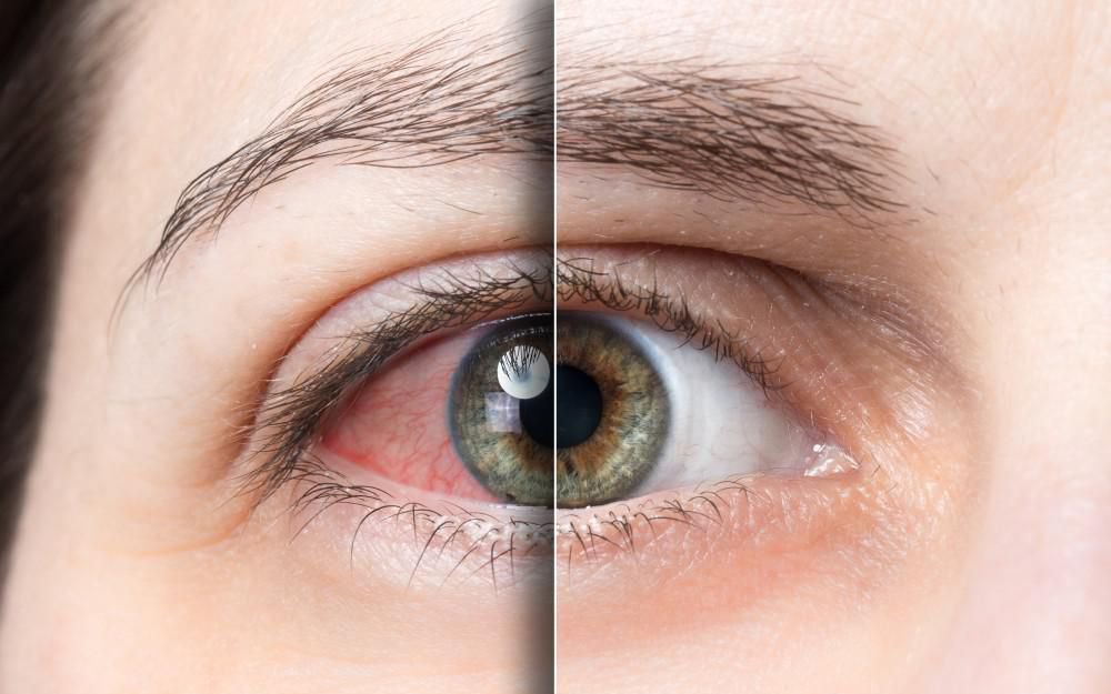 Nhận biết và điều trị khô mắt tránh suy giảm thị lực