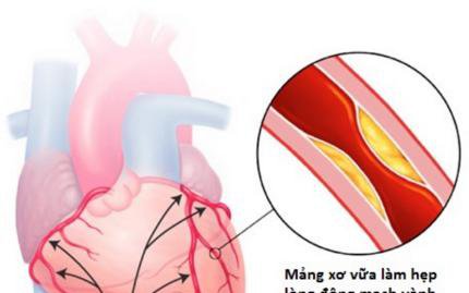 Bài thuốc từ linh chi hỗ trợ điều trị bệnh mạch vành