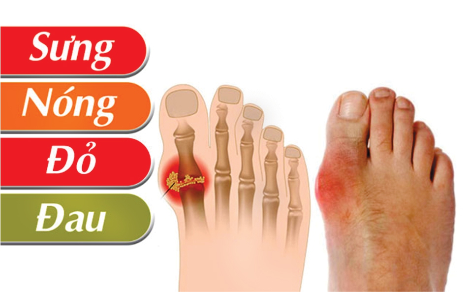 Người bệnh gout ăn gì ngày Tết để tránh cơn đau bùng phát?