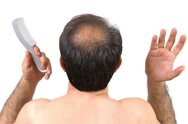 Rụng tóc ở nam tuổi 20 có đáng lo ngại Làm sao để khắc phục