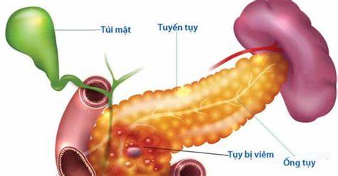 Viêm tụy cấp do rượu và những biến chứng đe dọa tính mạng - Ảnh 2.