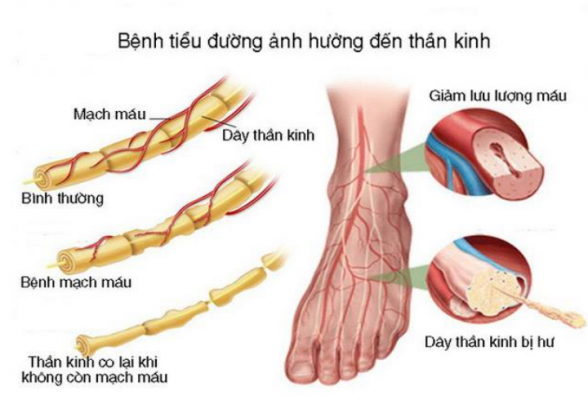 Điều trị bệnh thần kinh đái tháo đường - Ảnh 1.