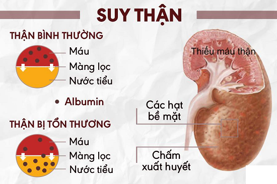 Điều trị biến chứng thận ở bệnh nhân đái tháo đường - Ảnh 1.