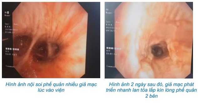 Tự chữa cúm tưởng khỏi, nào ngờ chạy ECMO 37 ngày 'thập tử nhất sinh' - Ảnh 1.