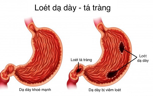 Các thuốc điều trị loét dạ dày tá tràng, dùng thế nào cho đúng?