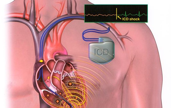 Kiểm soát nhiễm trùng cho bệnh nhân sử dụng thiết bị điện tử cấy ghép tim mạch - Ảnh 1.