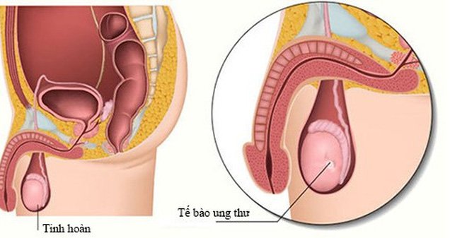 Tự Kiểm Tra và Phòng Ngừa U Tinh Hoàn