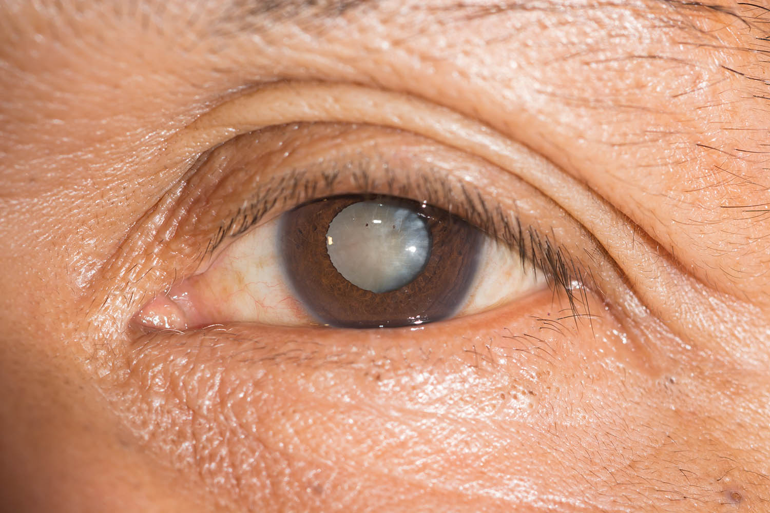 Bệnh nhân tiểu đường thường gặp phải những bệnh về mắt nào? - Ảnh 2.