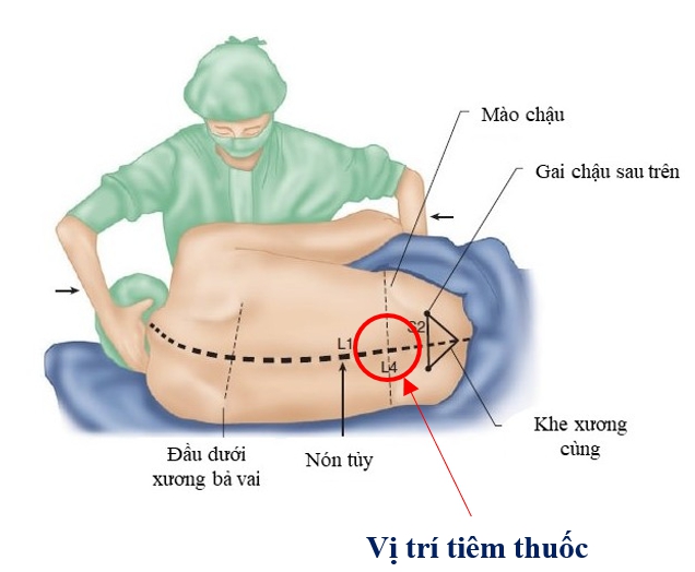 Gây tê tủy sống có tác dụng phụ gì, khắc phục thế nào? - Ảnh 2.