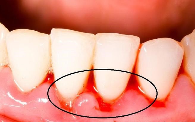 Chảy máu chân răng cần phải biết 5 cách khắc phục dưới đây