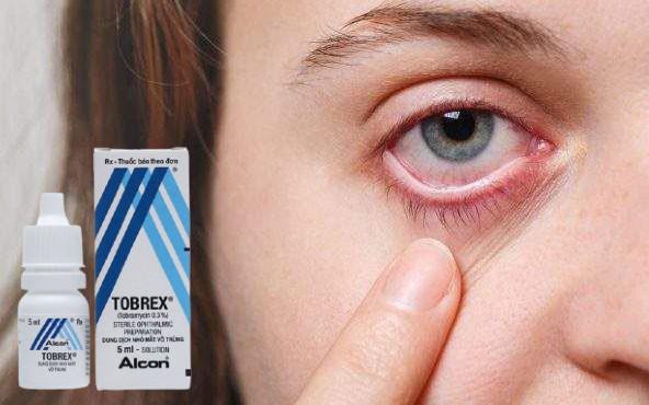 Thuốc đau mắt đỏ tobrex dùng trong trường hợp nào?