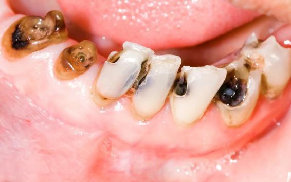 Sâu răng sữa có cần điều trị không?- Ảnh 3. 5 dấu hiệu cảnh báo sâu răng và cách phòng ngừa