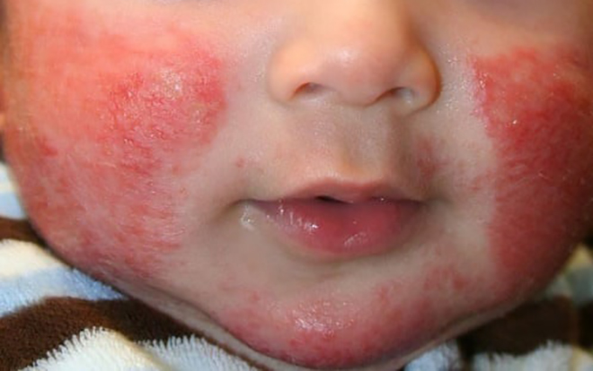 Bé trai bị bội nhiễm viêm da cơ địa, cần chăm sóc da cho trẻ đúng cách - Ảnh 2.