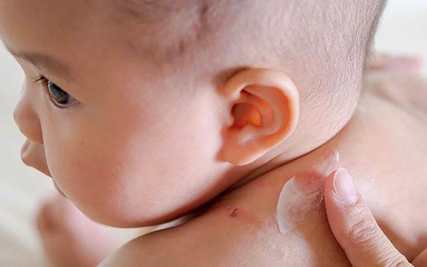 Viêm da cơ địa ở trẻ em dễ tái phát, biện pháp chăm sóc da đúng cách