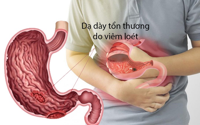 Căng thẳng dễ gây đau bụng, đau dạ dày