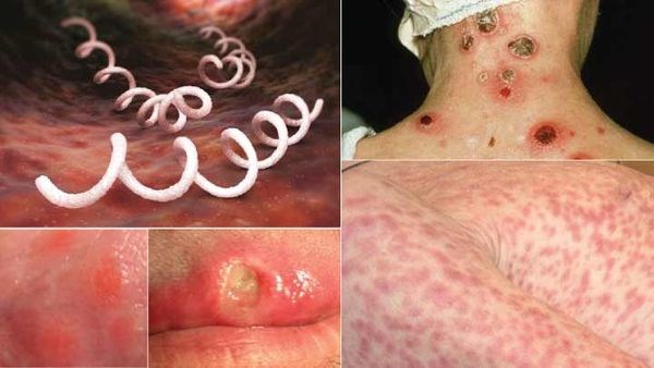 Dự phòng lây nhiễm giang mai và HIV - Ảnh 3.