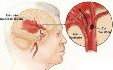 "Thủ phạm" ít được để ý nhưng nguy cơ cao gây đột quỵ não