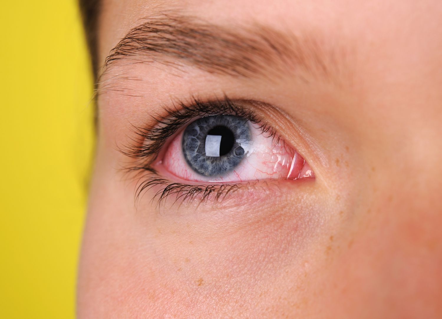 6 sai lầm trong điều trị đau mắt đỏ - Ảnh 2.