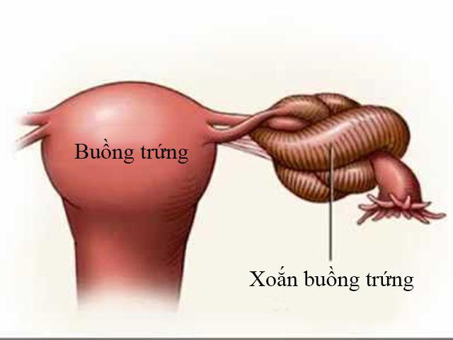 U nang buồng trứng xoắn nguy hiểm thế nào, cách phát hiện sớm - Ảnh 2.