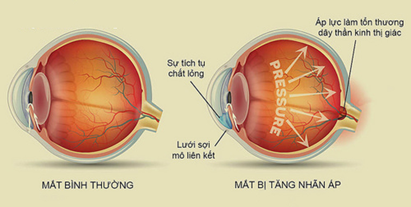 Nguy cơ múc nhãn cầu do tự điều trị bệnh đau mắt đỏ - Ảnh 3.