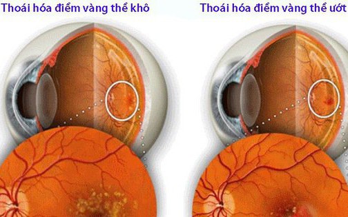 Ngăn thoái hóa điểm vàng ở người cao tuổi với 5 lưu ý sau