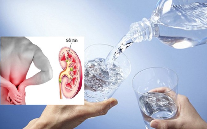Người bị sỏi thận nên uống bao nhiêu nước mỗi ngày?