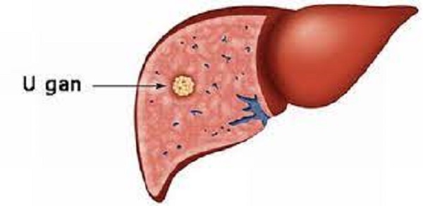 U gan có phải là ung thư gan không? - Ảnh 1.