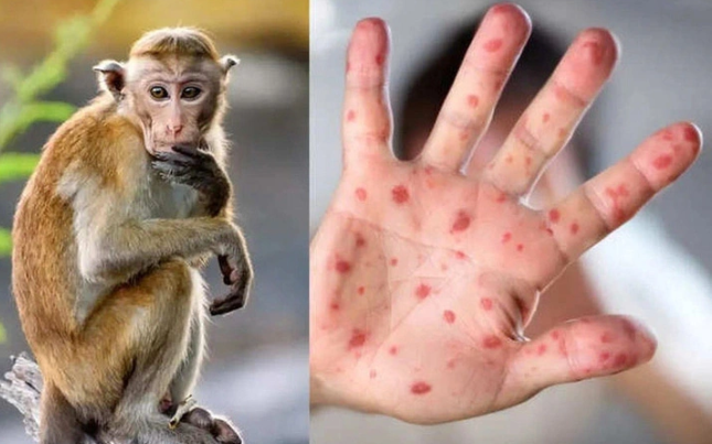 Bến Tre ghi nhận bệnh nhân đậu mùa khỉ