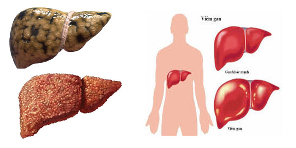 Gan bị tổn thương sẽ dẫn tới chức năng gan bị suy giảm mạnh, trong đó nguy hiểm và phổ biến nhất là ung thư gan.