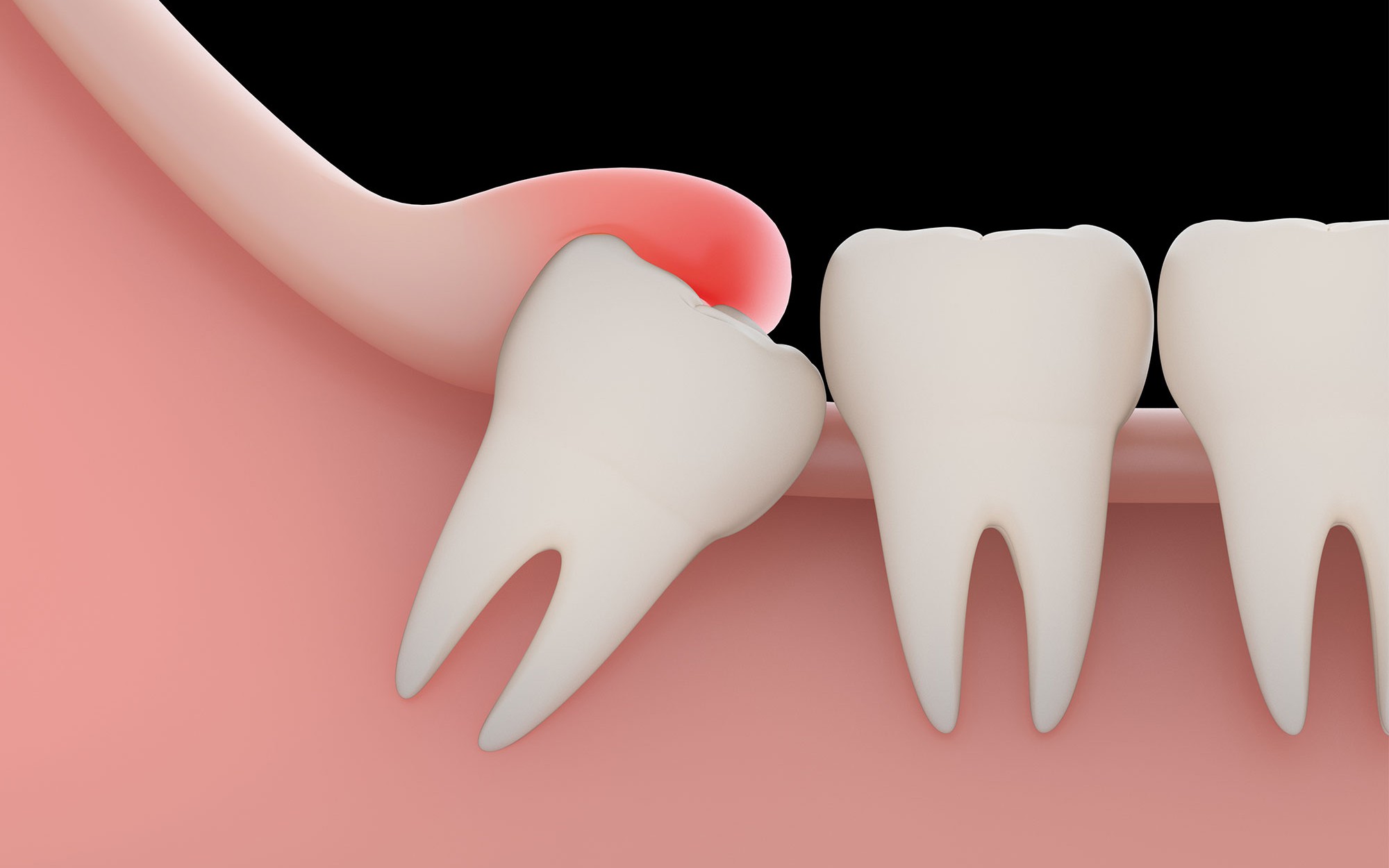 Răng khôn mọc lệch, ngầm gây biến chứng gì?