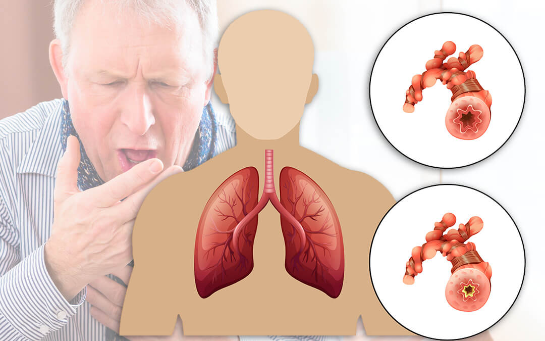 Bệnh phổi tắc nghẽn mạn tính (COPD): Nóng lạnh đan xen dễ bùng phát các đợt cấp của COPD