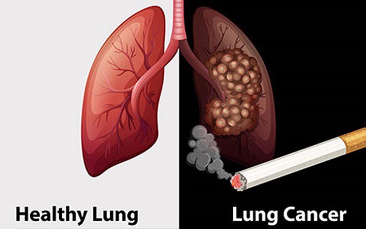 Gần 97% bệnh nhân ung thư phổi có hút thuốc lá