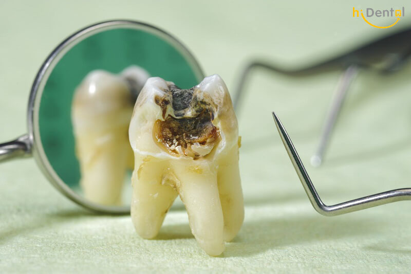 5 vấn đề sức khoẻ răng miệng thường gặp ở người nhiễm HIV- Ảnh 1.
