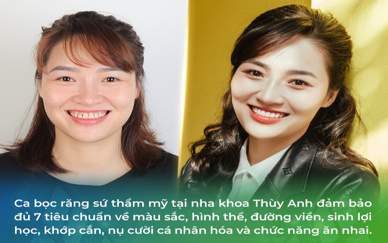 Trước khi mài răng để bọc sứ, đừng quên 4 câu hỏi này- Ảnh 2.