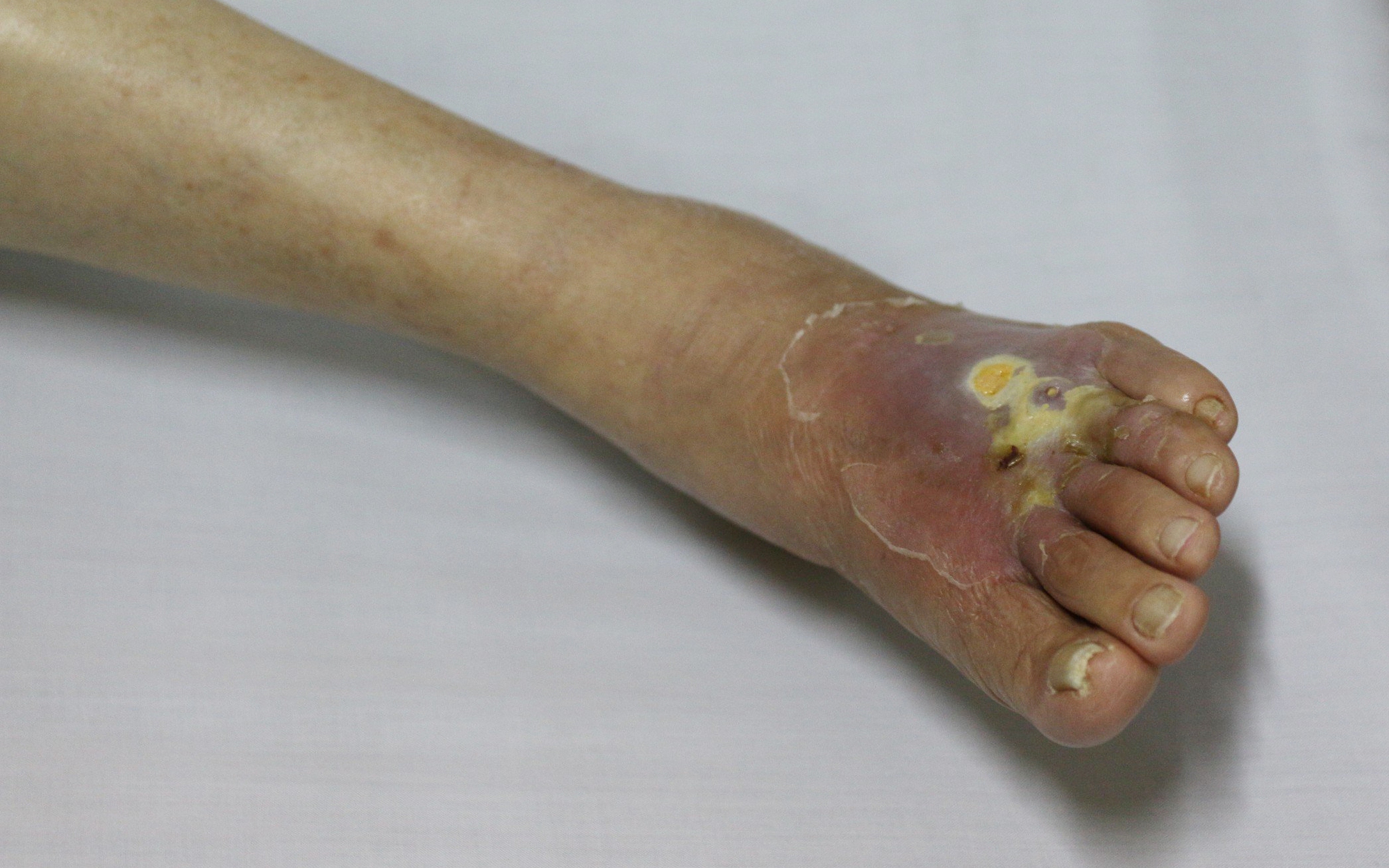 Vì sao người bệnh đái tháo đường cần cẩn trọng khi cắt móng chân?