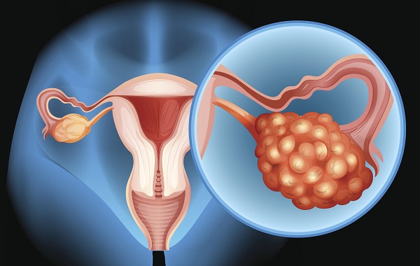 Ung thư buồng trứng phổ biến thứ 3 trong các bệnh ung thư ở nữ giới, sau ung thư vú và ung thư tử cung.