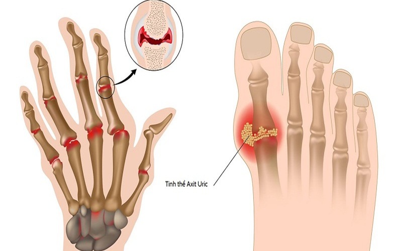 6 cách giảm acid uric máu liên quan đến bệnh gout