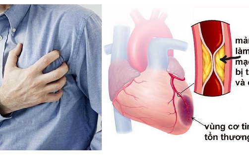 4 yếu tố gây nhồi máu cơ tim cấp cần lưu ý