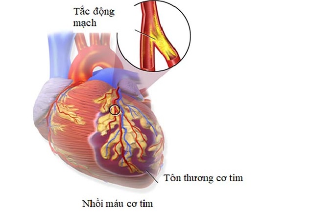 Các yếu tố chính gây nhồi máu cơ tim cấp cần biết - Ảnh 2.