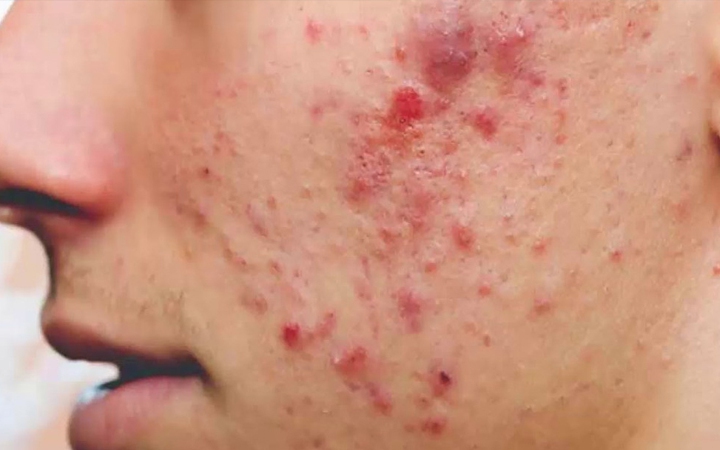 Cách dùng vitamin A khắc phục da khô và trứng cá