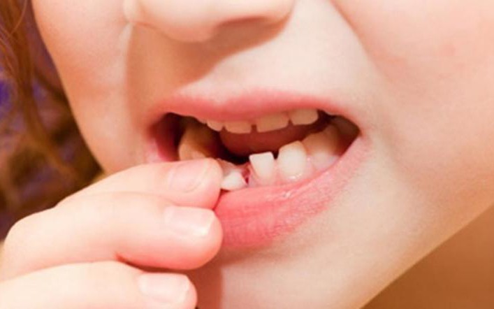 5 lưu ý quan trọng khi thay răng sữa ở trẻ