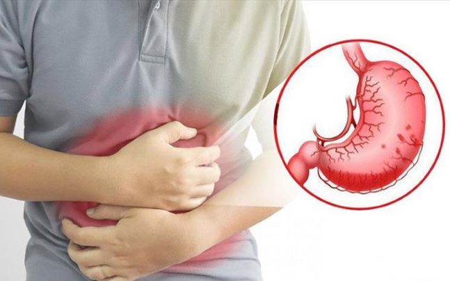 Bệnh đau dạ dày có những triệu chứng khá giống và liên quan đến nhiều bệnh lý tiêu hóa khác. Ảnh minh họa