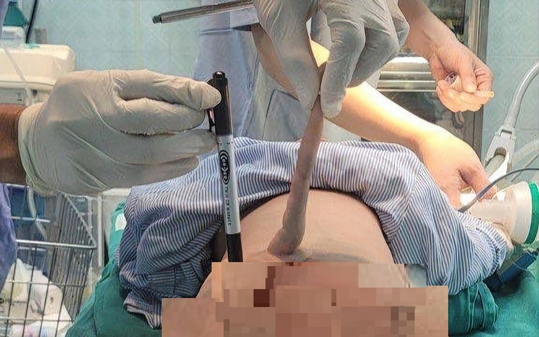 Trẻ sinh ra đã có đuôi dị tật bẩm sinh hiếm gặp, cha mẹ cần làm gì để ngăn ngừa dị tật sơ sinh?