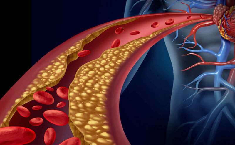 3. Triệu chứng của rối loạn mỡ máu