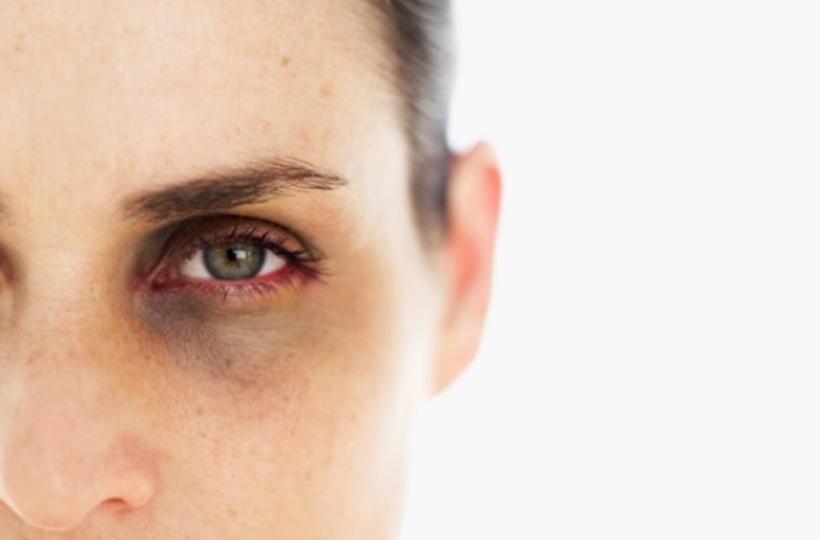 Cách nào hiệu quả giúp loại bỏ quầng thâm mắt?- Ảnh 1.