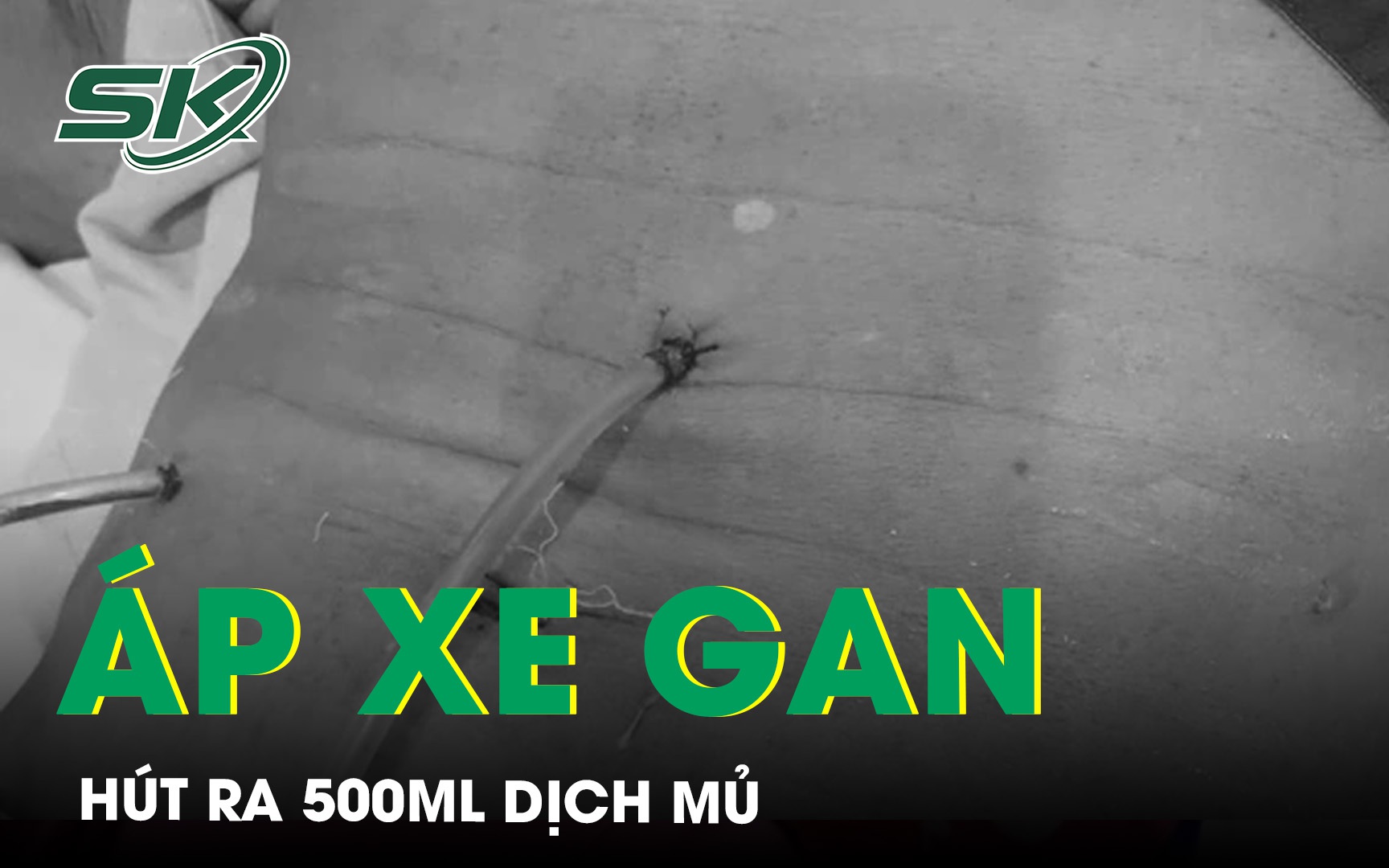 Áp xe gan hút ra 500ml dịch mủ